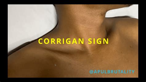 Corrigan sign